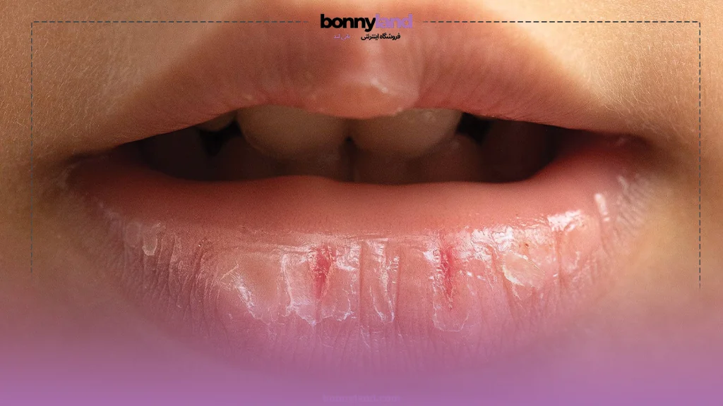 علل شایع خشکی و ترکخوردگی لب